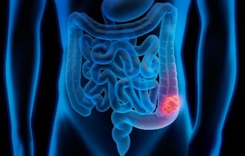 Bowel Cancer Screening